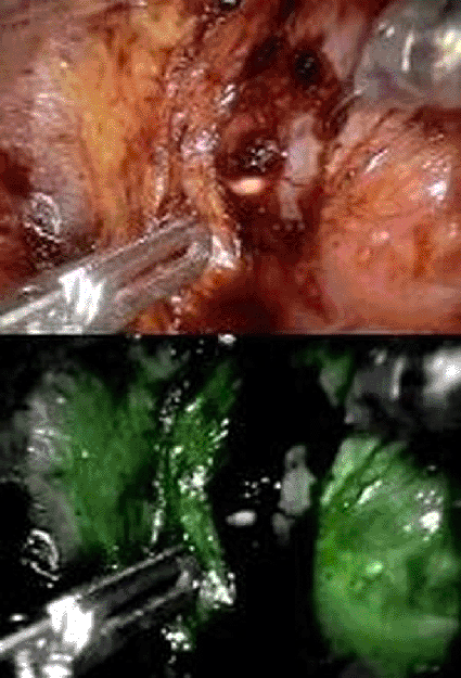 Image: Tissue before and after injection with a NIR fluorescent dye (Photo courtesy of NYU Langone Medical Center).